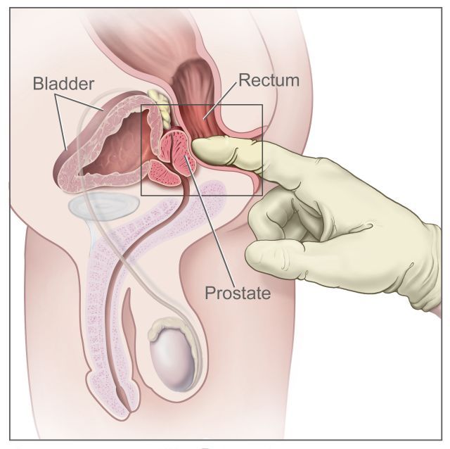Benigno povećanje prostate – pregled, simptomi i liječenje | Kreni zdravo!
